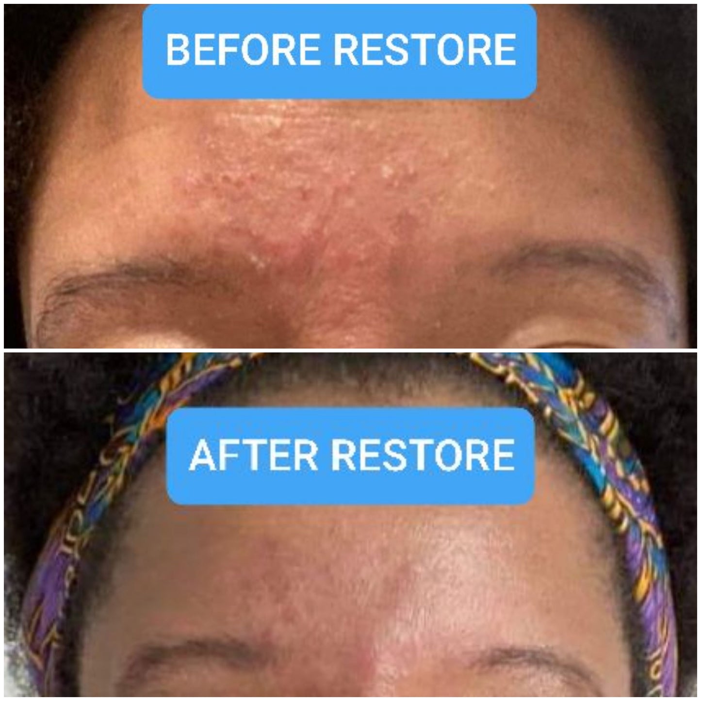 RESTORE Skin Healing Mist for Skin & Scalp Inflammation