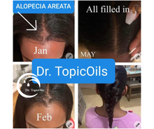 Load image into Gallery viewer, Dr. TopicOils Alopecia Repair Balm Growth Kit For Slow Hair Growth avd Early Stage Alopecia