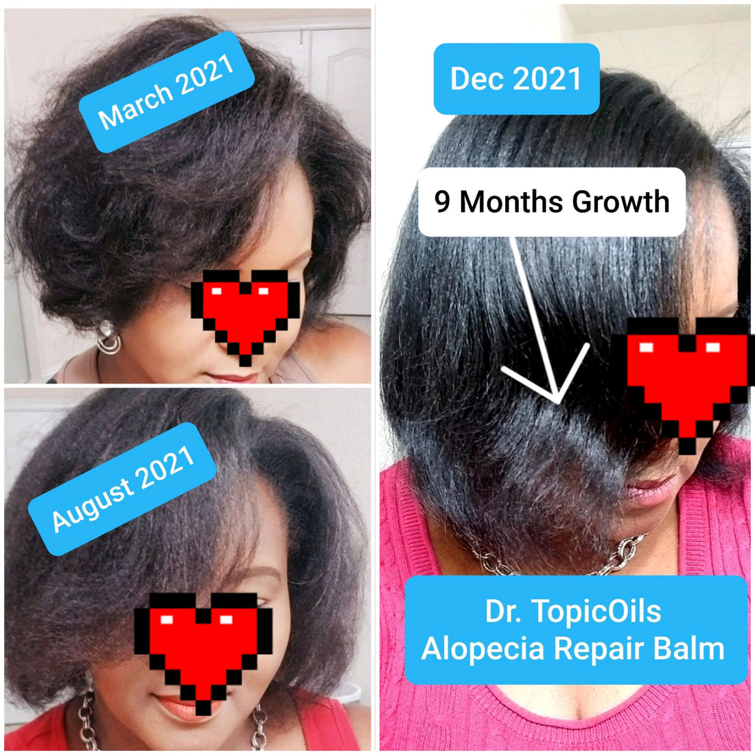 Dr. TopicOils Alopecia Repair Balm for Slow Growing Hair