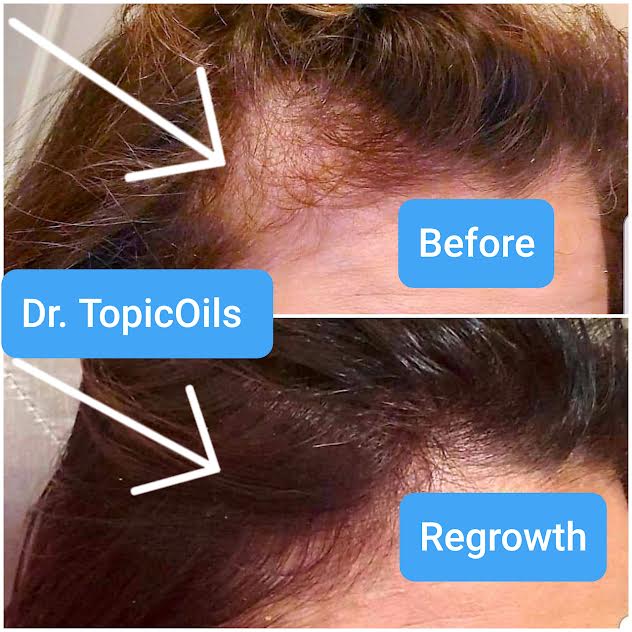 Dr. TopicOils: How I Grew My Hair Back (Stress-Related Hair Loss)
