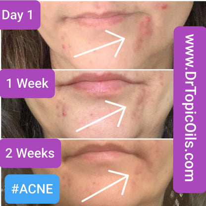 RESTORE Skin Healing Mist for Skin & Scalp Inflammation