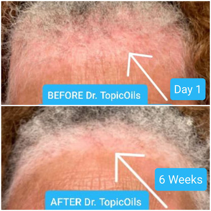 RESTORE Skin Healing Mist for Skin & Scalp Inflammation