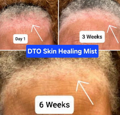 RESTORE Skin Healing Mist for Skin & Scalp Inflammation