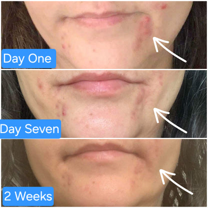RESTORE Skin Healing Mist for Skin & Scalp Inflammation