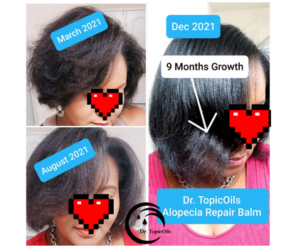 Dr. TopicOils Alopecia Repair Balm
